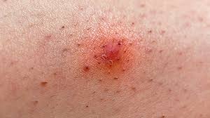 doctor about an infected ingrown hair
