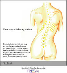 scoliosis overview scoliosis texas