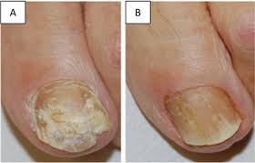 onychomycosis recommendations for
