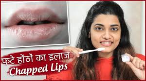 home remedy for chapped lips फट