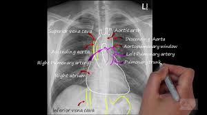 It is almost always the first imaging study ordered to evaluate for pathologies of the thorax, although further diagnostic imaging, laboratory tests. Chest X Ray Normal Chest X Ray Interpretation Normal Anatomy On A Cxr Youtube