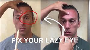 How you can fix your lazy eye without surgery! How To Fix Your Lazy Eye Case 1 Posturepro Youtube
