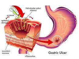 top 10 home remes for stomach ulcers