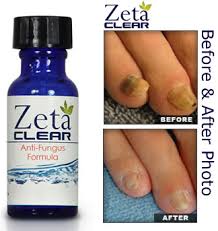 zetaclear toenail fungus treatment
