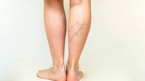 don t leave varicose veins untreated
