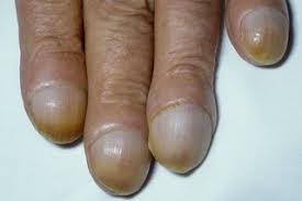 nail problems nhs