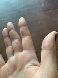 Dry skin can make your hands and feet itchy. Is My Skin Rash A Covid 19 Symptom