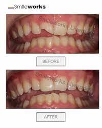 Is tooth bonding covered by insurance? Composite Bonding Liverpool Best And Worst Of 2020 Compared