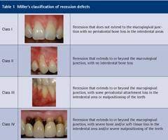 gcsc periodontology exam 2 3