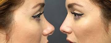 would you have a non surgical nose job