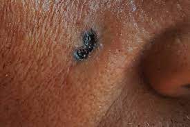 symptoms of non melanoma skin cancer nhs
