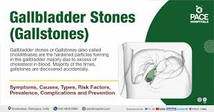 gallstones gallbladder stones