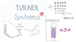 What Is Turner Syndrome
