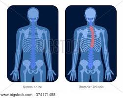Backbone in a computer network is the innermost conduit which is designed to transport traffic at a very high speed amongst attached systems. Types Scoliosis Spine Vector Photo Free Trial Bigstock