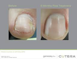 laser toenail fungus removal cosmetic