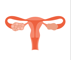 polycystic ovary syndrome treatment in