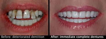 The dentist will provide you with temporary immediate dentures as the gum tissue how much does it cost to get all your teeth pulled and get dentures? Immediate Dentures Denture Professionals Rockingham Pinjarra
