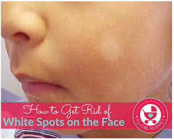 white spots on the face of your child