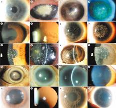 corneal dystrophies nature reviews