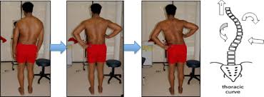 physiotherapy scoliosis specific