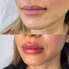 lip fillers and injections in los angeles
