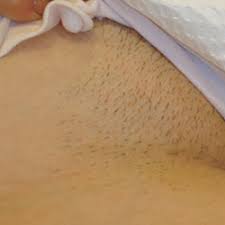 Sometimes i want it long, sometimes i want to cut it all off. Laser Hair Removal Before After Patient 2493 Memorial Houston