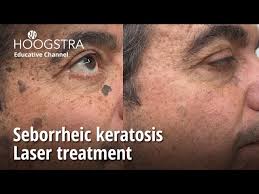 seborrheic keratosis laser treatment