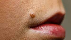 a mole on your lip