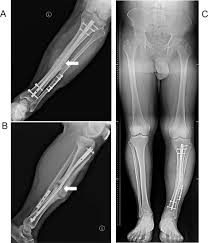 remove a broken intramedullary nail