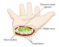 Image result for icd 10 code for bilateral carpal tunnel