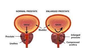 However, if you have a family history of prostate cancer, then you have a higher risk. Prostate Cancer A Guide For Aging Men Updated For 2021