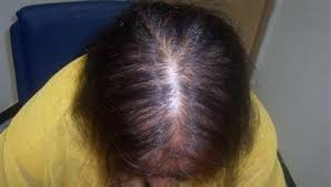 Both options will improve hair growth within 6 to 12 months and be continually used to see results. How To Stop Hair Fall And Help To Regrow It Quora