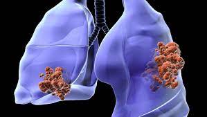 Les différents types et stades de cancer du poumon - Doctissimo