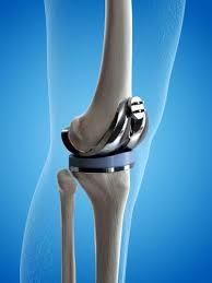 knee replacement what you should know