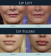 lip lift plastic surgery