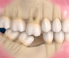 Dental Onepro - Consecuencias de la perdida de un diente.... | Facebook