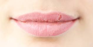 what causes chapped lips onlymyhealth