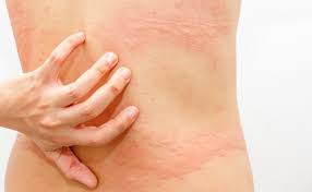 types of eczema dermais herpetiformis