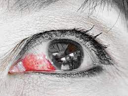 burst blood vessel in the eye