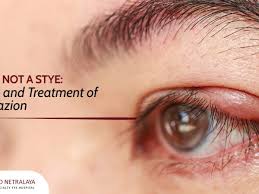 causes and treatment of a chalazion
