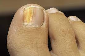 yellow toenail fungus