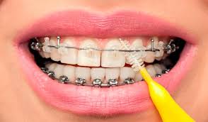 Submitted 6 years ago by djiley. Caring For Braces Top Tips On Caring And Wearing Braces
