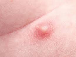 An ingrown hair follicle can cause extreme pain on the privates, areola, and mouth. Ingrown Hair On Scrotum Sack And Crotch Bump Removal Solution And Treatment Nubo Beauty