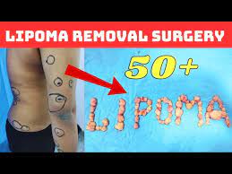 50 lipoma removal surgery lipoma