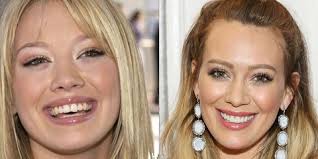 Wherever you sit, know it's a completely normal part of. 10 Celebrities With Veneers Celebrities Who Had Major Teeth Transformations