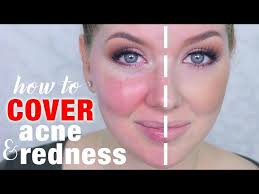 how to cover acne redness