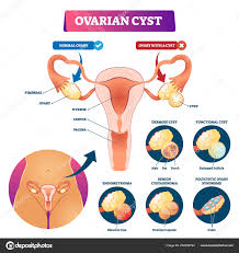 ovarian cyst vector ilration