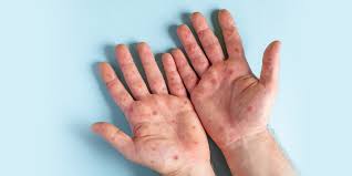 are monkeypox scars permanent tips to