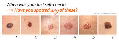What skin cancer looks like when it starts? What Skin Cancer Looks Like Inlifehealthcare