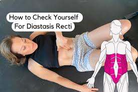 how to check for diastasis recti
